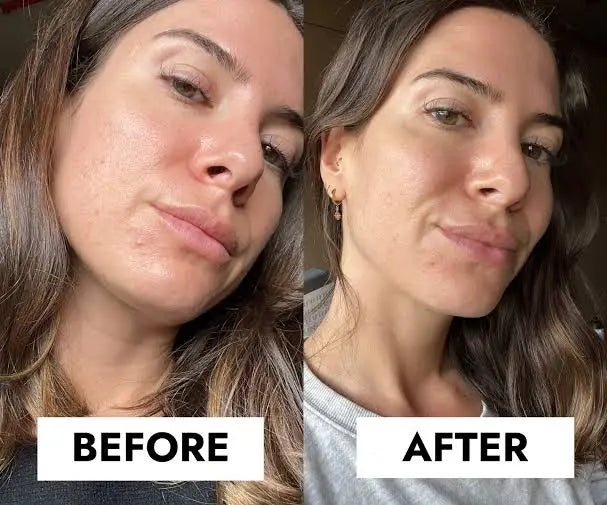 CeraVe Blemish Control Gel Moisturiser with 2% Salicylic Acid & Niacinamide for Blemish-Prone Skin 40ml