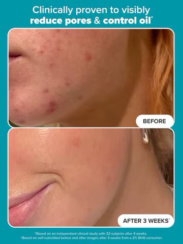 Paula's Choice  Skin Perfecting 2% BHA Liquid Exfoliating Toner for Clear Skin