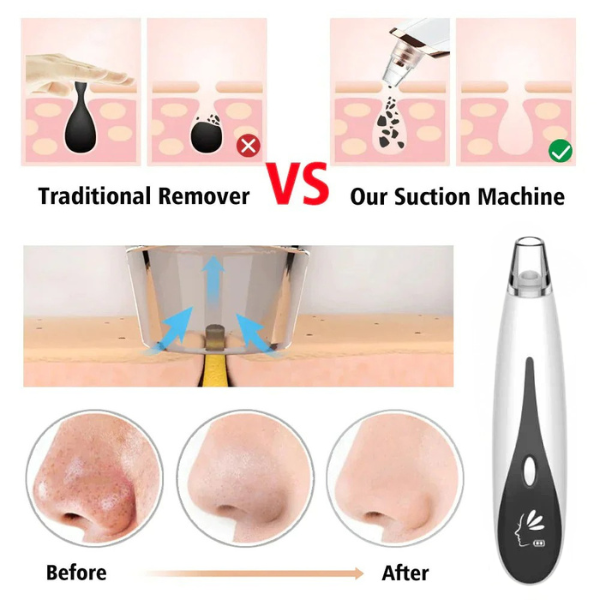 Rechargeable Blackhead Remover Vacuum Cleaner | mnshop.pk