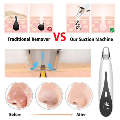 Rechargeable Blackhead Remover Vacuum Cleaner | mnshop.pk