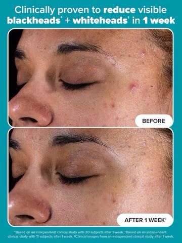 Paula's Choice  Skin Perfecting 2% BHA Liquid Exfoliating Toner for Clear Skin