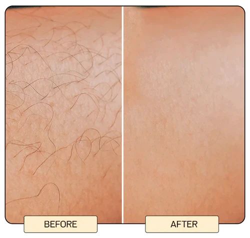 BabyVerse Professional IPL Laser Permanent Hair Removal